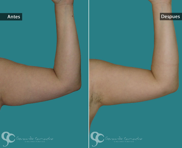 Testimonio braquioplastia Bogota